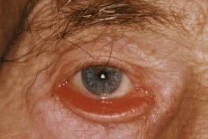 Lidchirurgie - winti vision Medical Center AG